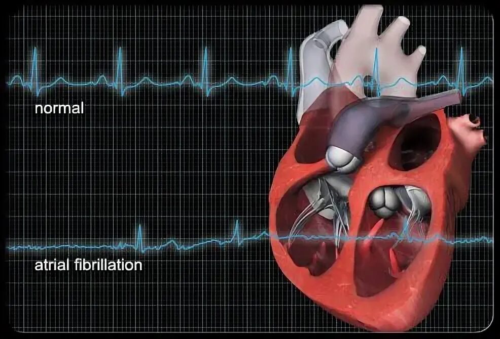 Нарушение ритма сердца фото Pin on Exercise Science