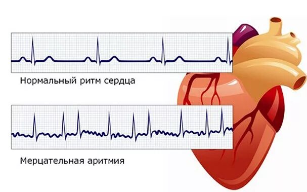 Нарушение ритма сердца фото Лечение ишемической болезни сердца (ИБС) в Москве: цены в клинике, врачи, отзывы