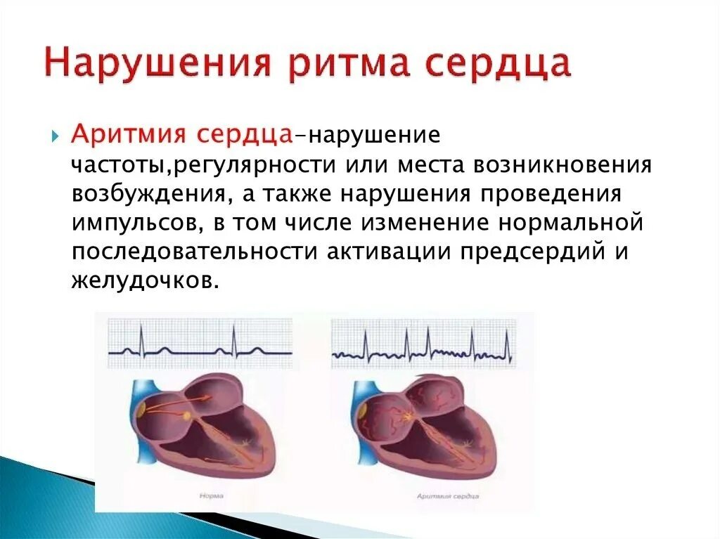 Нарушение ритма сердца фото КАК ПОМОЧЬ СЕБЕ ПРИ АРИТМИИ Всё о здоровье Фотострана Пост № 2094548354