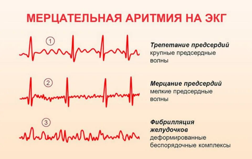 Нарушение ритма сердца фото Сердечно-сосудистые заболевания - лечение гомеопатией Доктор Долинина