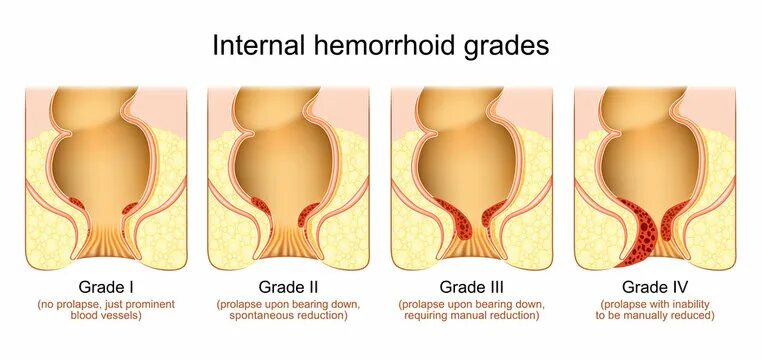 Наружный геморрой фото начальная стадия Rectal Prolapse Зображення - огляд 1,419 Стокові фото, векторні зображення й від