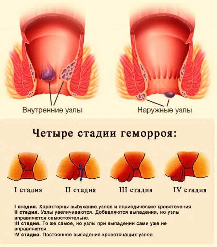 Наружный геморрой фото начальная стадия Выпадение геморроидальных узлов фото у женщин - Азимут Тур
