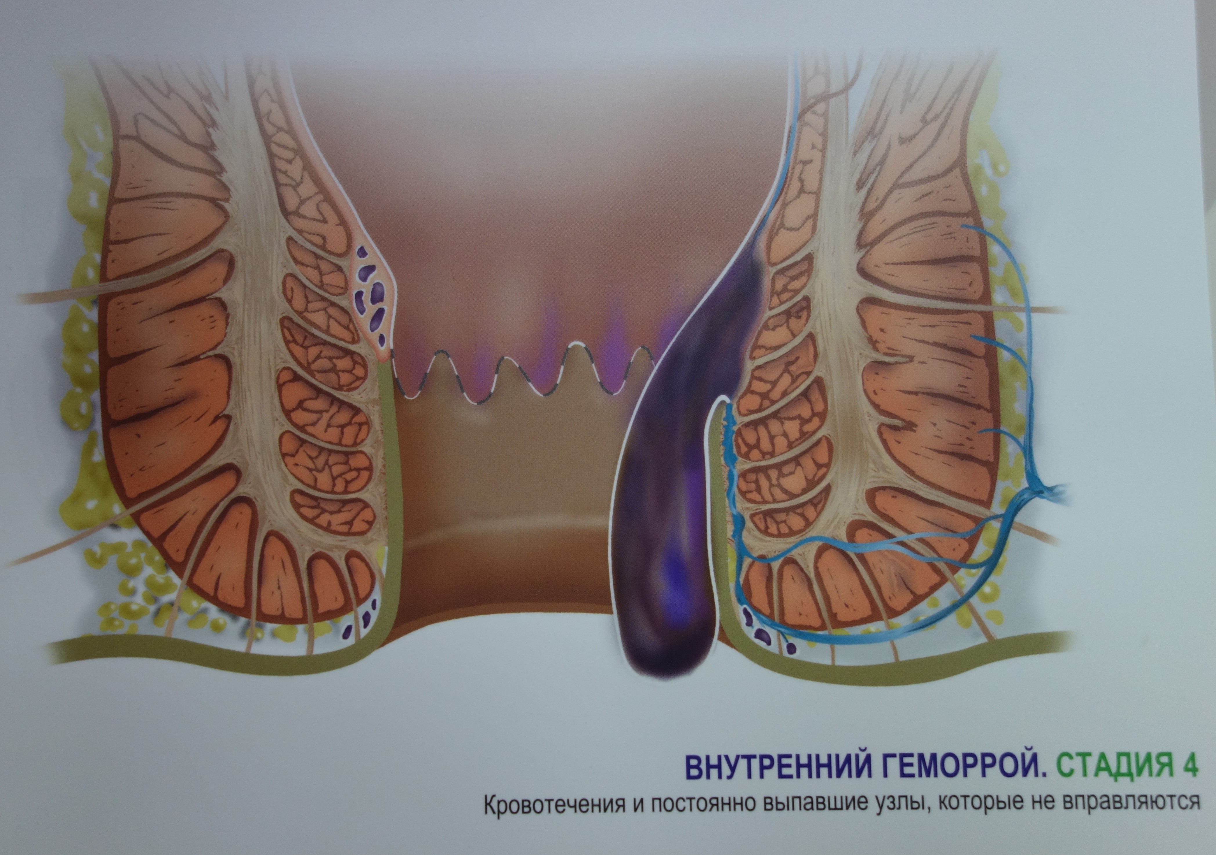 Наружный геморрой фото начальная стадия Лигирование узлов латексным кольцом