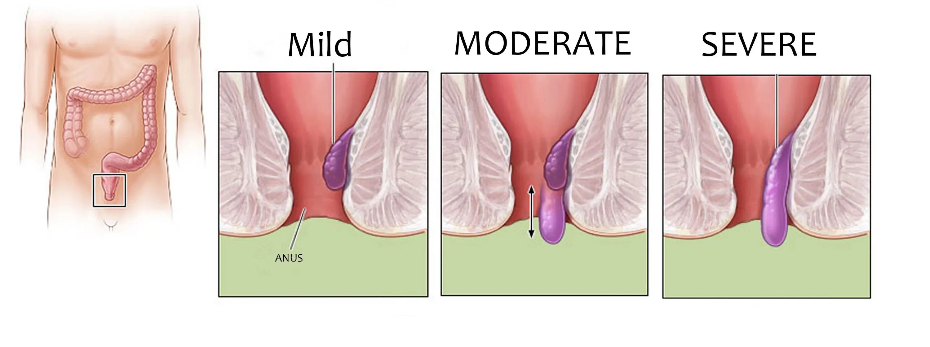Наружный геморрой фото начальная стадия Hemorrhoid laser 60w 980 17W 1470nm endolaser fistula piles anal diodo bare opti