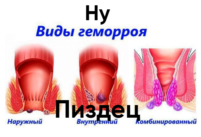 Наружный геморрой фото начальная стадия Steam Community :: Guide :: Как вычислить призрака по атаке + что они из себя мо
