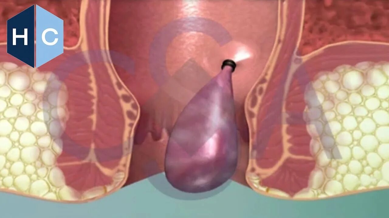 Наружный геморрой фото начальная стадия Rubber Band Ligation (RBL) Hemorrhoid Treatment - Houston TX - YouTube