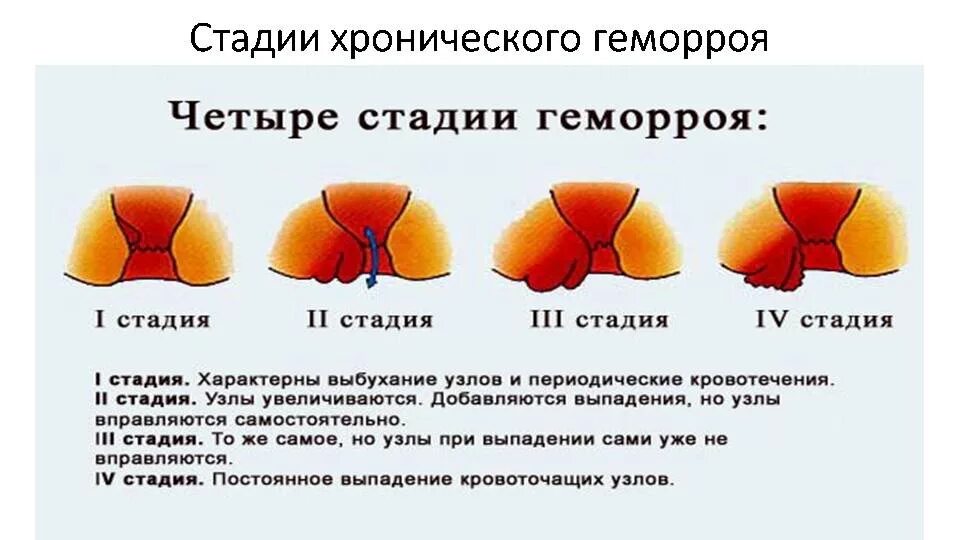 Наружный геморрой как выглядит в реальности Причины, симптомы и упражнения при геморрое у женщин Doctor-V.ru Медицинский Пор
