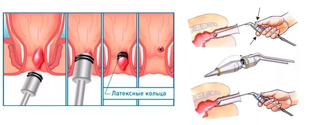 Наружный геморрой как выглядит в реальности Лигирование геморроидальных узлов в Новосибирске Клиника "Альфа Технологии"