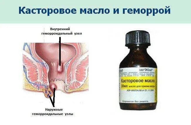 Наружный геморрой как выглядит в реальности Как избежать обострения геморроя во время велосипедной прогулки: советы от специ