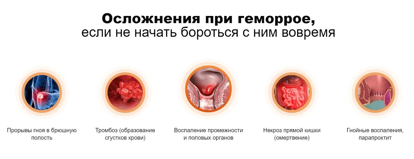 Наружный геморрой как выглядит в реальности Геморрой с кровотечением карта вызова