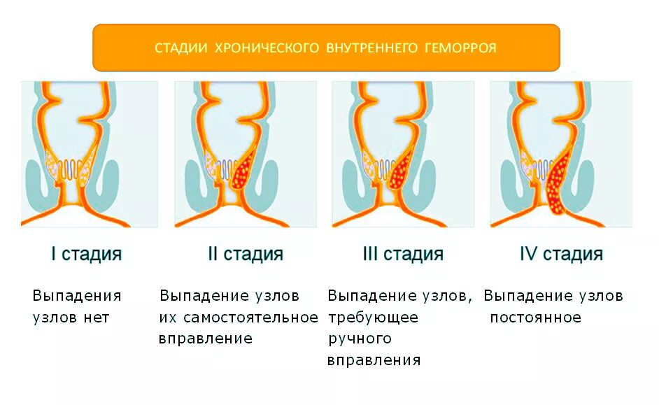 Наружный геморрой как выглядит в реальности Лечение геморроя клиника "Скандинавия"