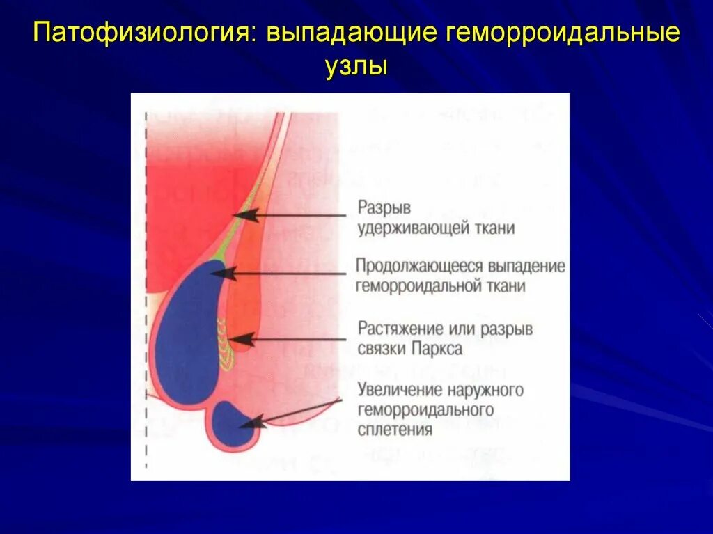 Наружный геморрой узлы как выглядит Почему болит геморрой: найдено 86 изображений
