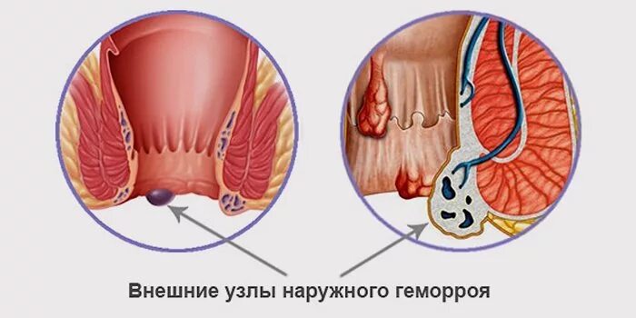 Наружный геморрой узлы как выглядит Наружный геморрой, способы лечения внешнего геморроя - Клиника лечения геморроя