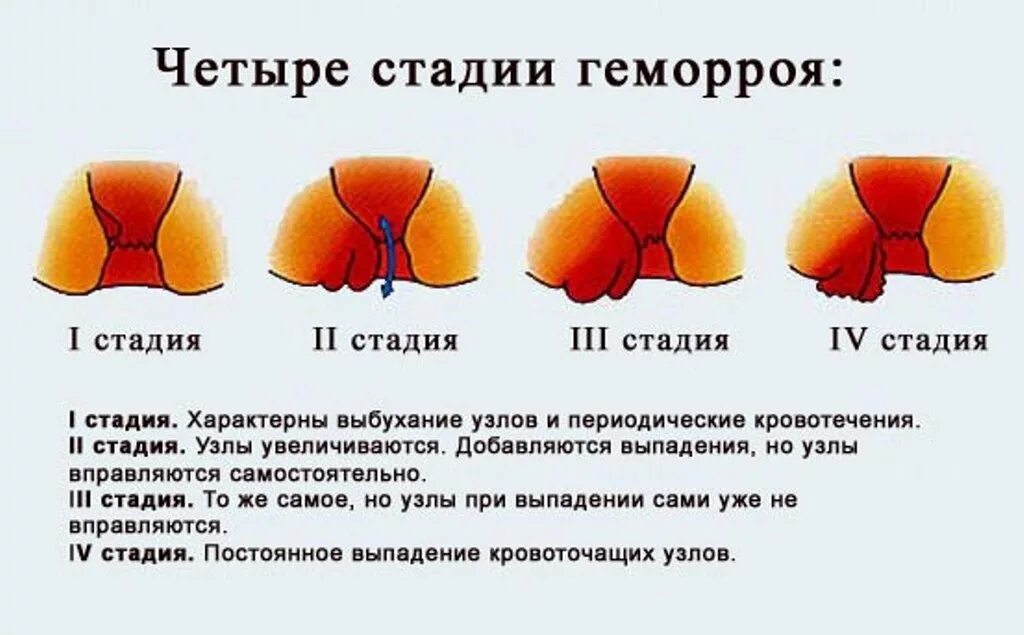 Наружный геморрой узлы как выглядит Геморрой не нужен никому! Или воспользуйтесь популярной методикой лечения от Vic