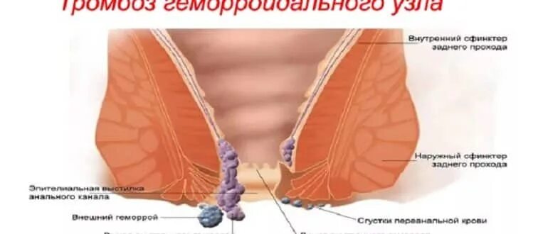 Наружный геморрой узлы как выглядит Как вправить геморроидальный узел самостоятельно: алгоритм действий