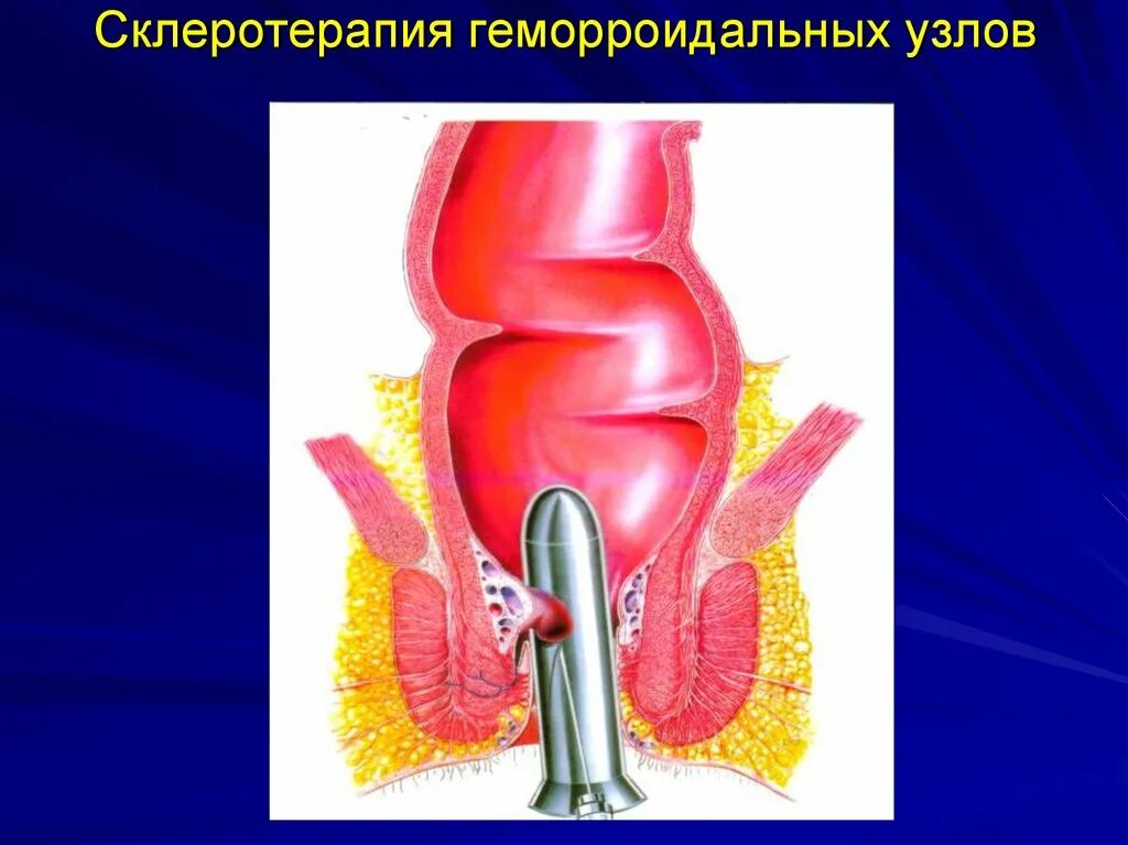 Наружный геморрой узлы как выглядит Наружное лечение узлов: найдено 90 изображений