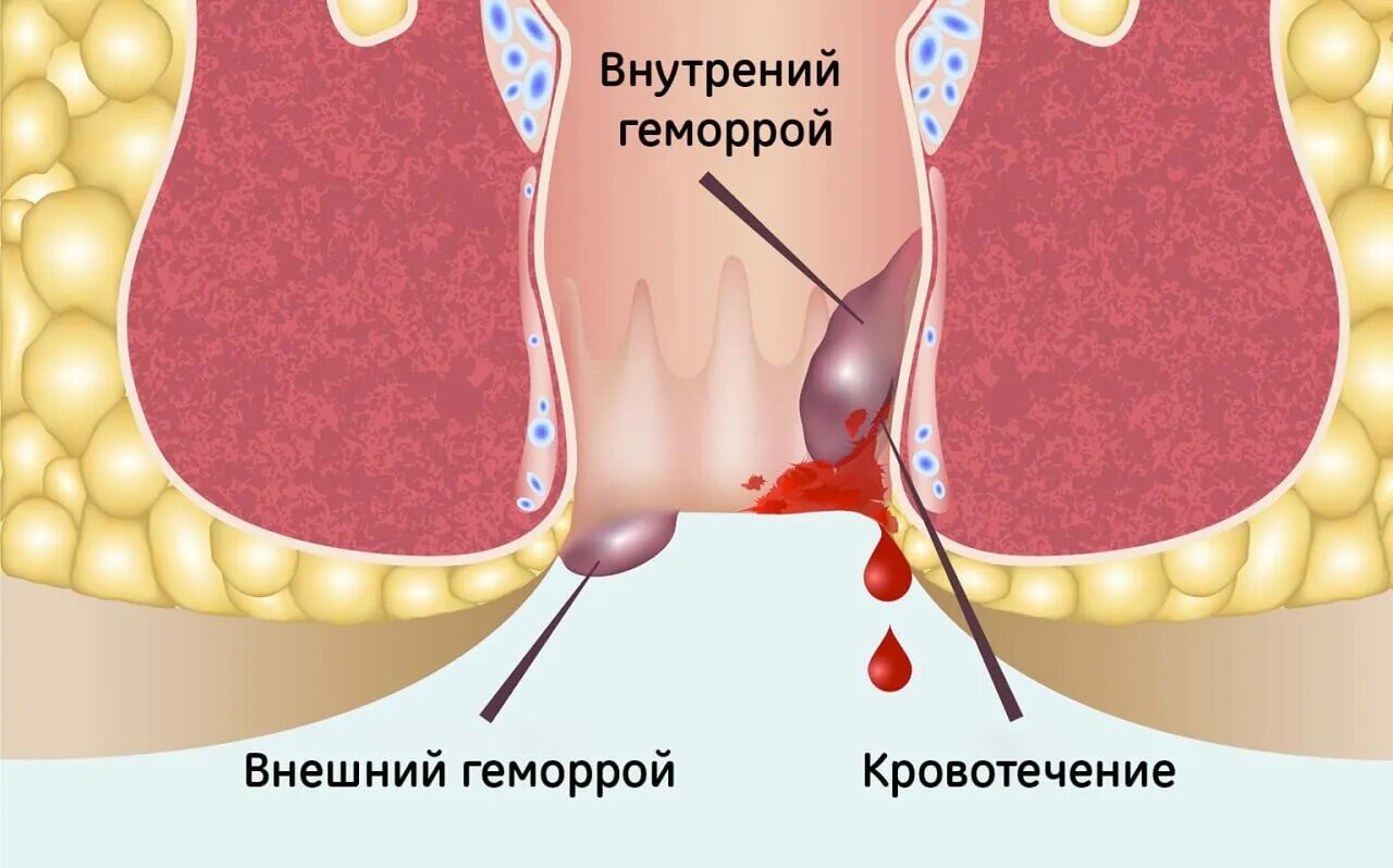 Наружный геморрой узлы как выглядит Хронический геморрой: причины, симптомы, лечение "Нейромедикс"