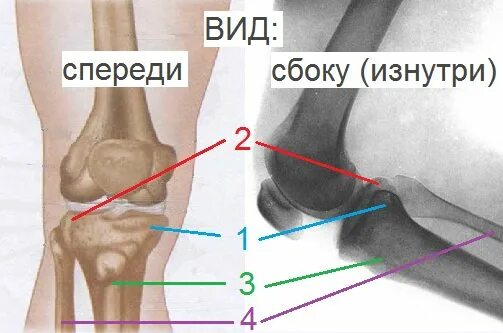 Наружный мыщелок большеберцовой кости фото Перелом Внутреннего (Латерального) Мыщелка Большеберцовой Кости