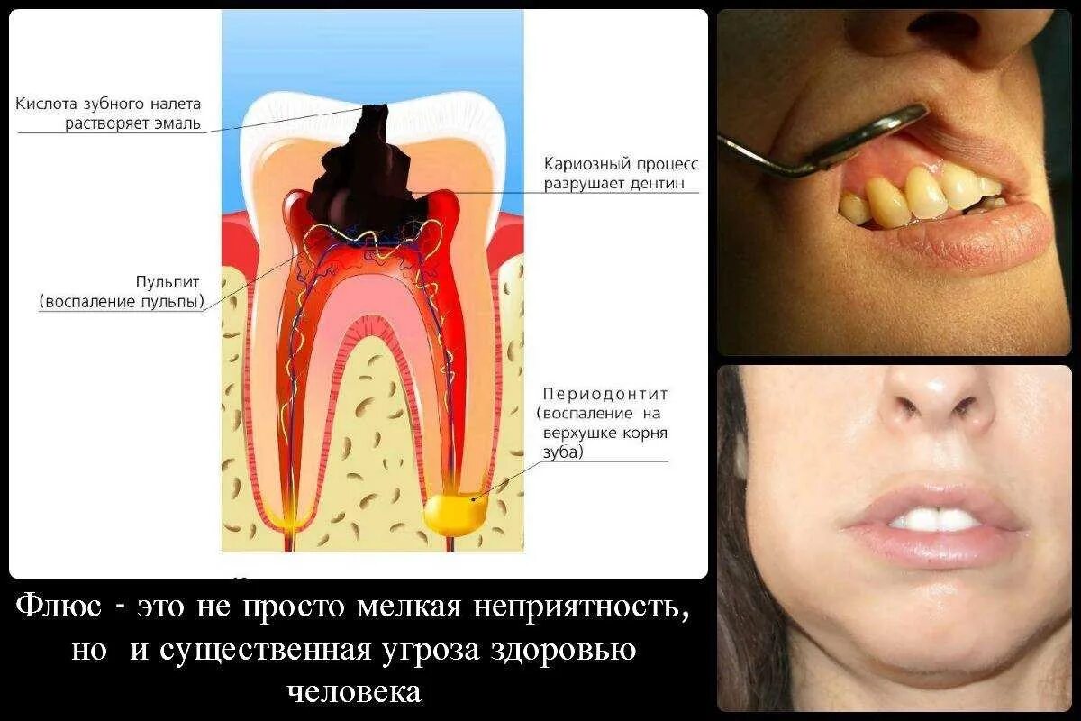 Нарыв на десне около зуба как выглядит Периодонтит зуба: цена лечения от 9 000 ₽ в Москве от стоматологии Дио Дент