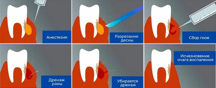 Нарыв на десне около зуба как выглядит Абсцесс зуба - что такое, причины, симптомы. Как удалить гнойник