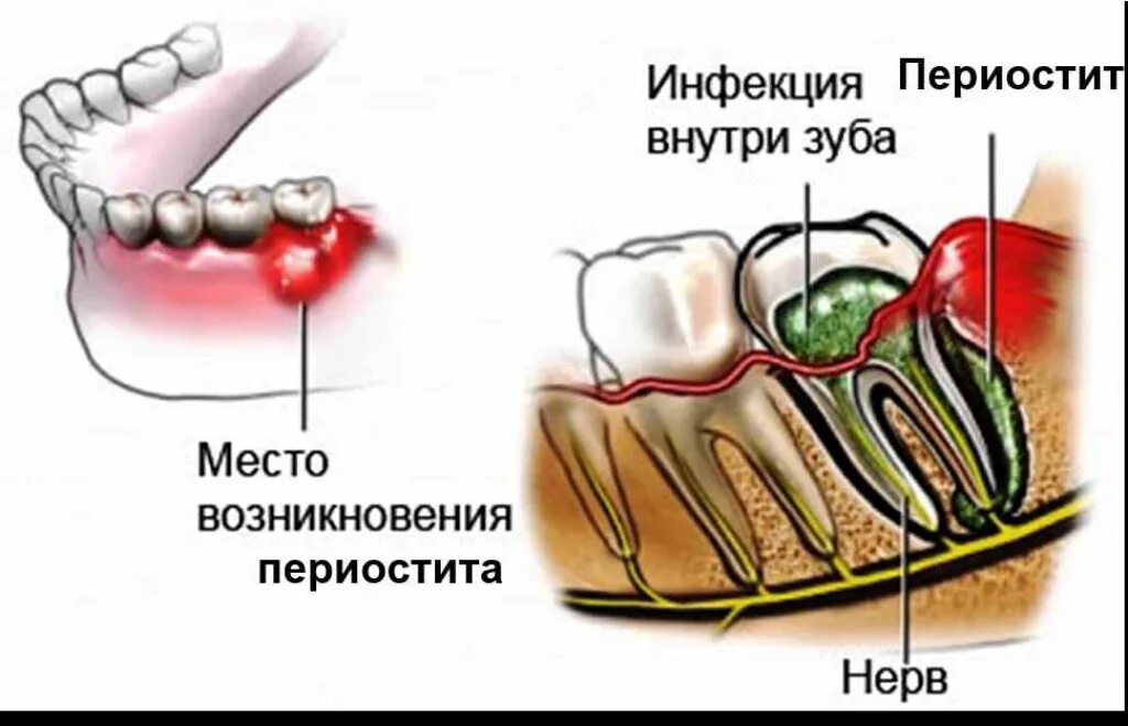 Нарыв на десне около зуба как выглядит Зубной флюс - симптомы и способы лечения