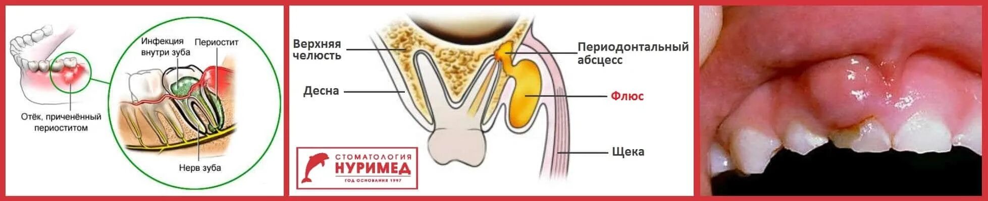 Нарыв на десне около зуба как выглядит Лечение флюса (периостита) - Нуримед