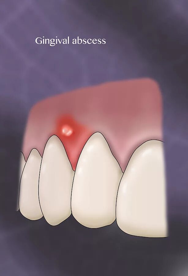 Нарыв на десне около зуба как выглядит Gingival Abscess, Illustration #1 Photograph by Monica Schroeder - Fine Art Amer