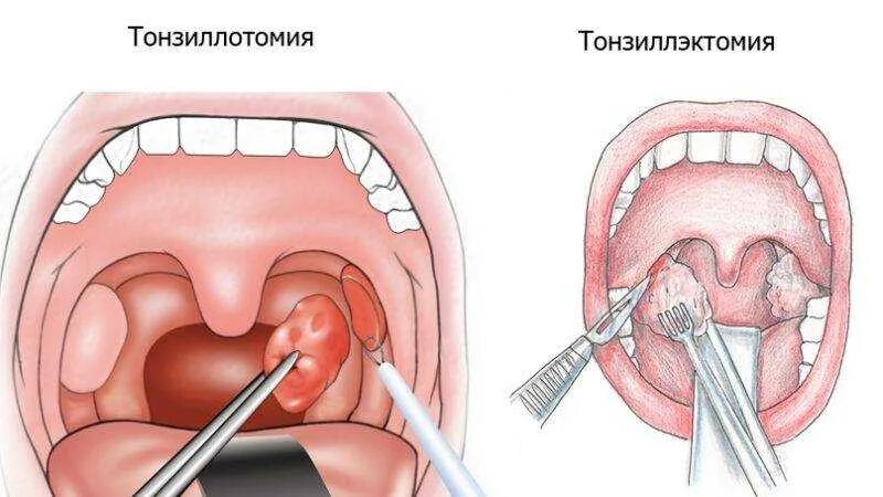 Нарывы в горле фото Удаление пробок из миндалин