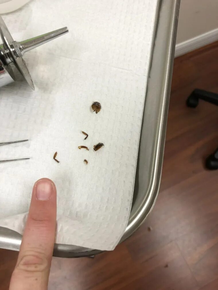 Насекомое в ухе фото Florida woman has live cockroach removed from her ear