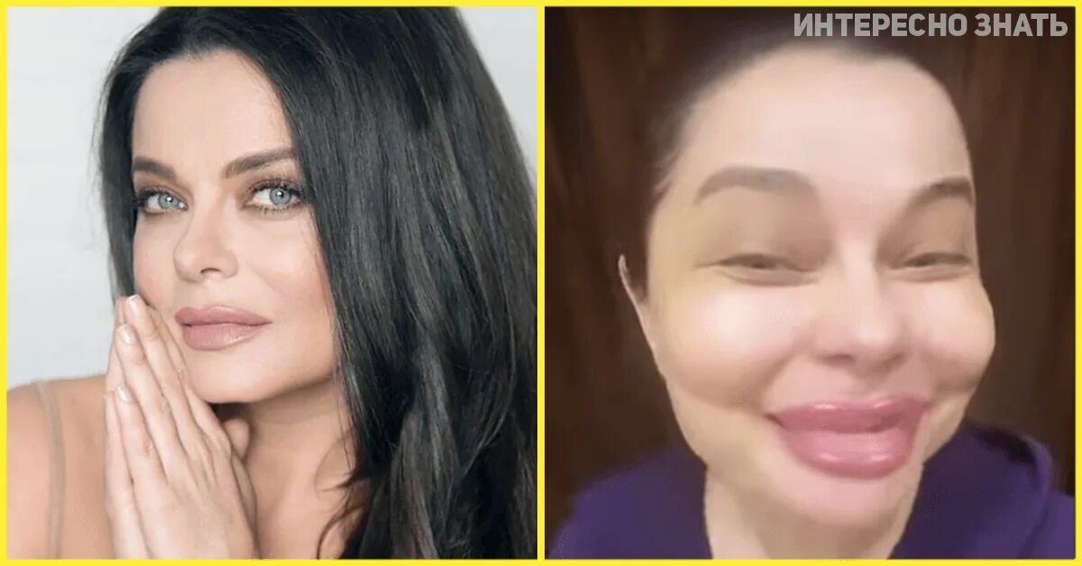 Наташа королева сделала пластику лица фото Что с лицом? Наташа Королева показала раздутые скулы и губы - О главном