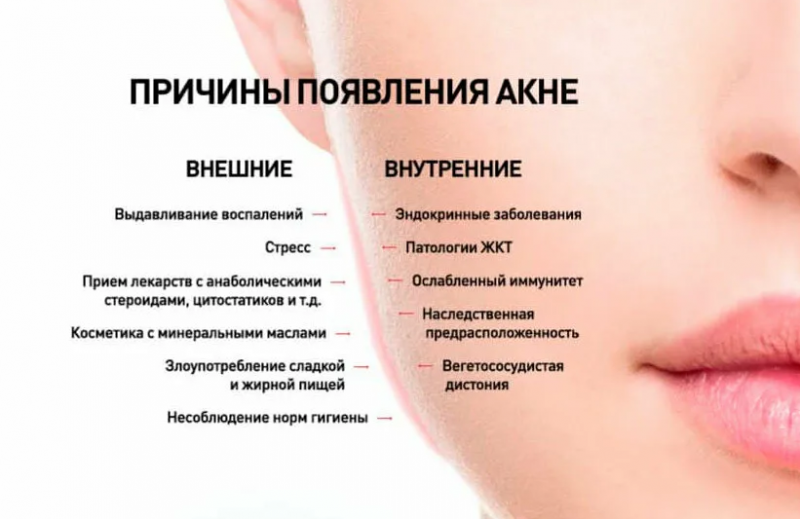 Названия и фото прыщей на лице Профилактика угревой сыпи у подростков