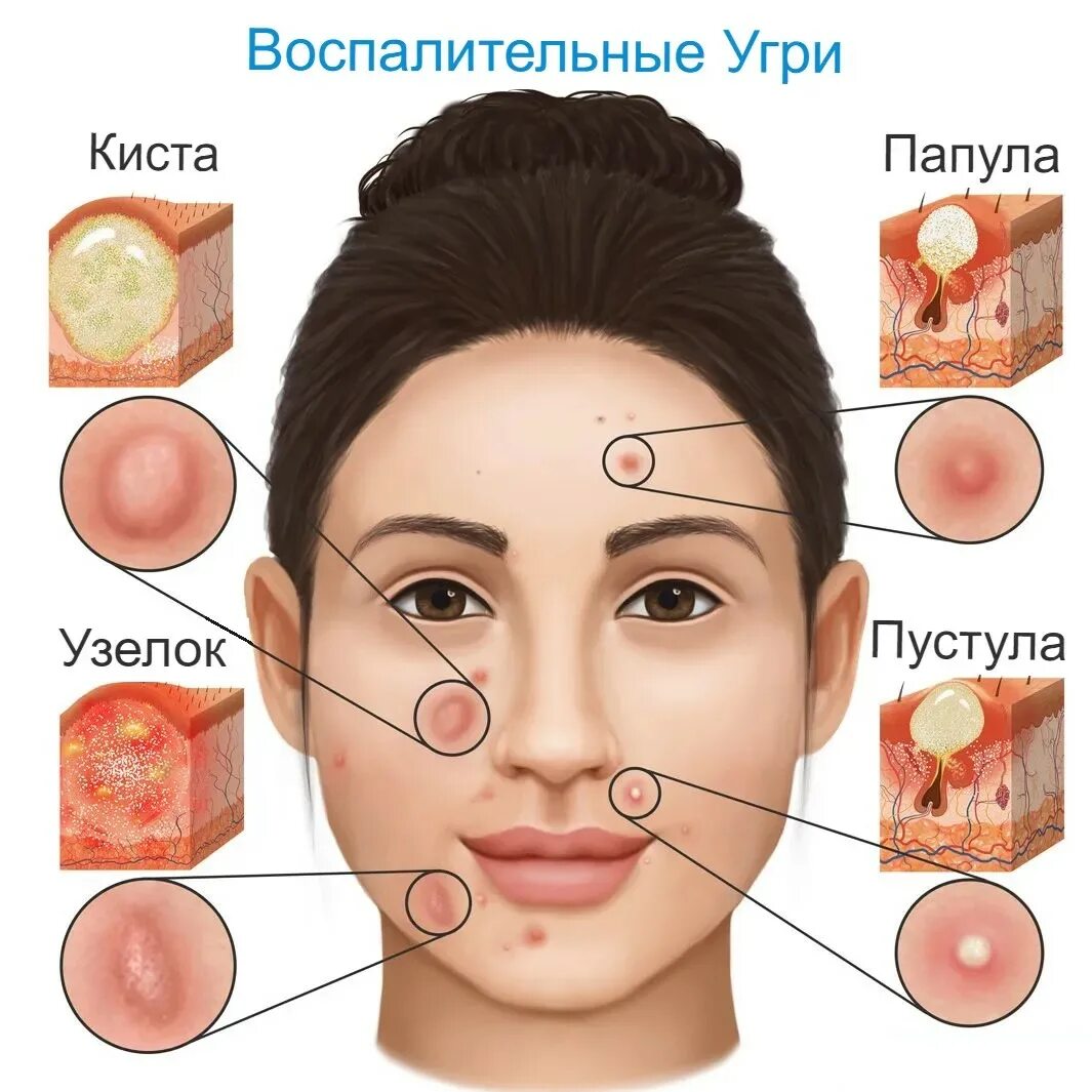 Названия и фото прыщей на лице Причины сыпи на лице у взрослых и ребенка. Высыпания у женщин - Medside.ru