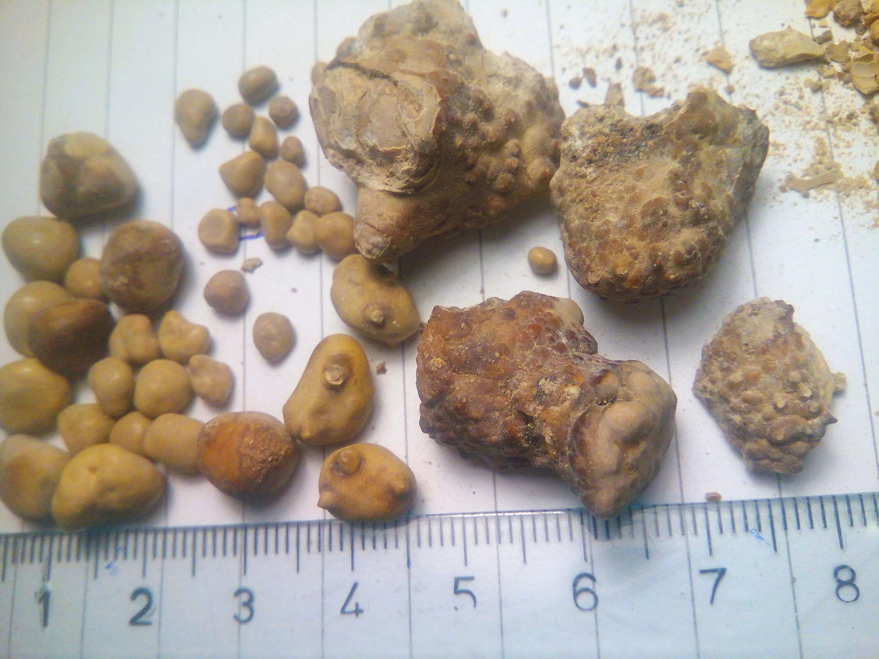 Названия камней в почках фото Файл:Kidney stones ( renal calculi ), Бубрежни камења 5.jpg - Википедия