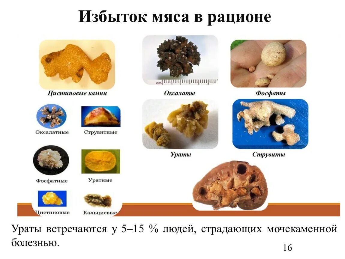 Названия камней в почках фото АКТУАЛЬНЫЕ ВОПРОСЫ ПРОФИЛАКТИКИ МОЧЕКАМЕННОЙ БОЛЕЗНИ
