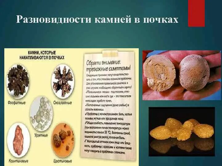 Названия камней в почках фото Картинки КАК ОПРЕДЕЛИТЬ КАКИЕ КАМНИ В ПОЧКАХ