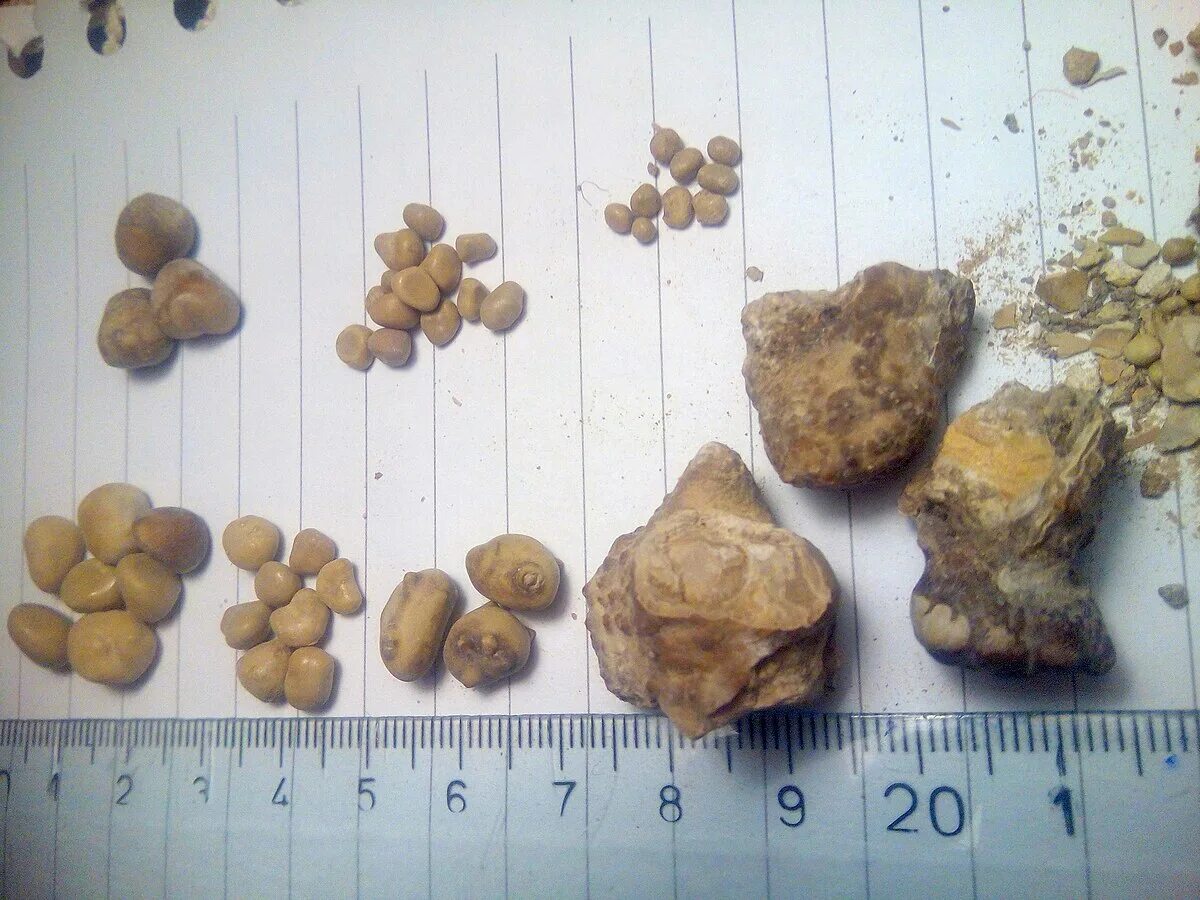 Названия камней в почках фото File:Kidney stones ( renal calculi ), Бубрежни камења 15.jpg - Wikimedia Commons