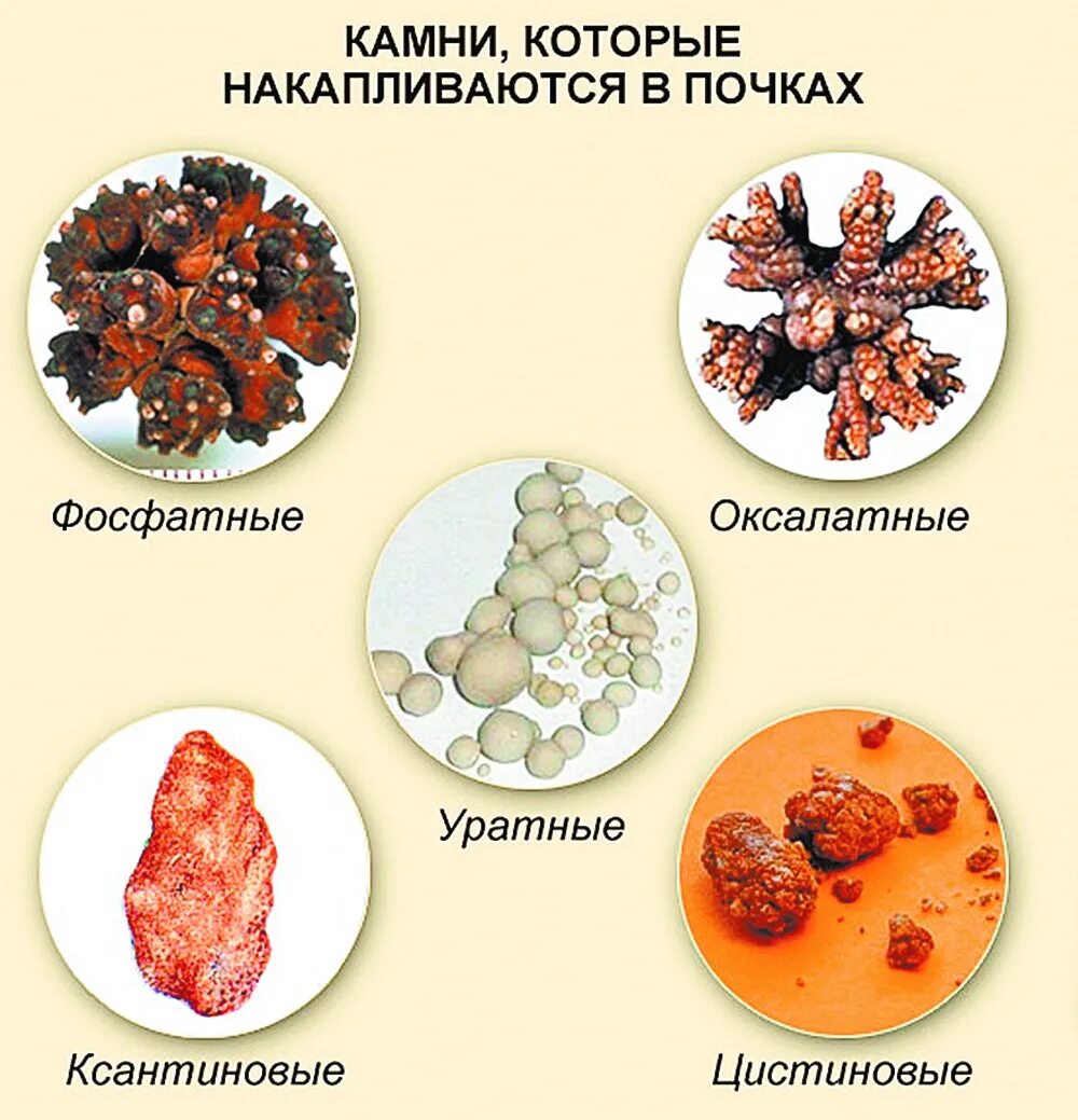 Названия камней в почках фото Доктор медицинских наук Алексей Мартов: Любой уважающий себя мужчина должен появ