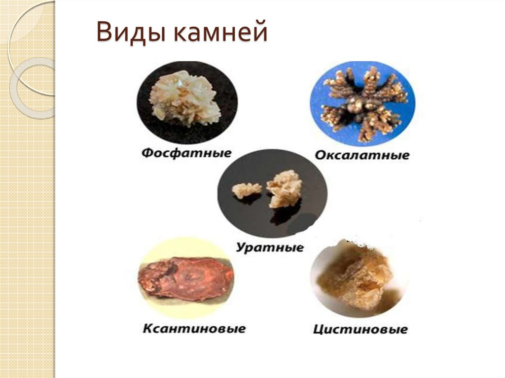 Названия камней в почках фото У МЕНЯ НАШЛИ КАМНИ В ПОЧКАХ!? ЧТО ДЕЛАТЬ!? ЛЕКС ДЗЕН Дзен