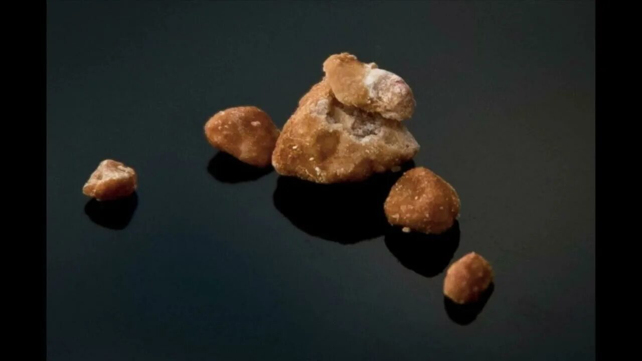 Названия камней в почках фото Kidney stones គ្រួសតំរងនោម - YouTube