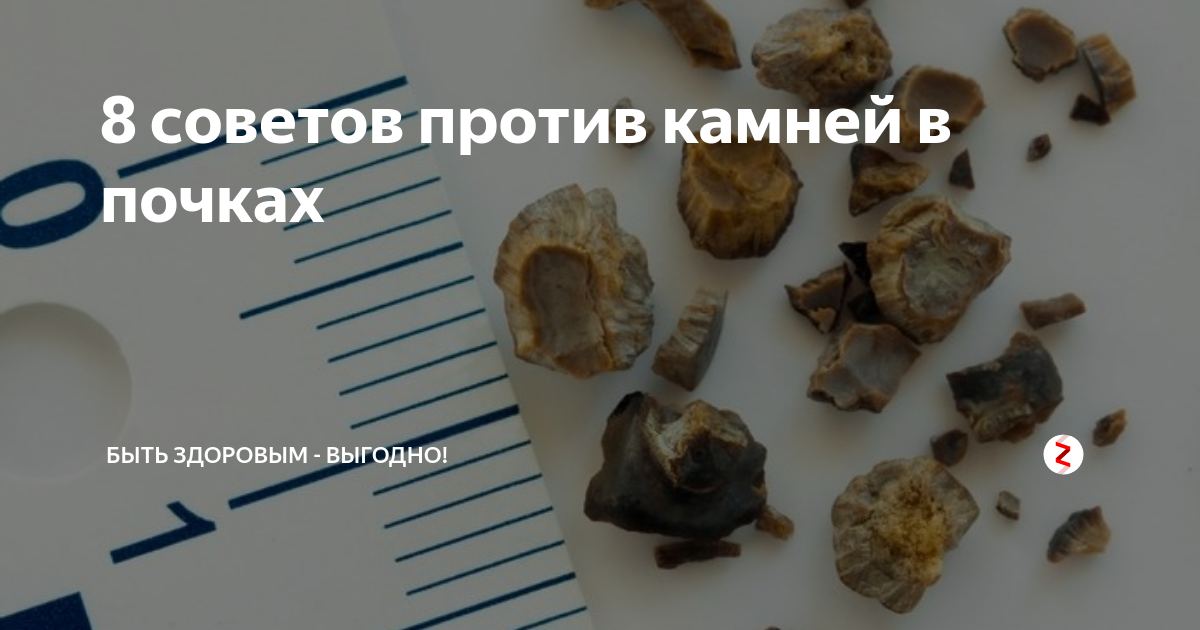 Названия камней в почках фото 8 советов против камней в почках Быть здоровым - выгодно! Дзен