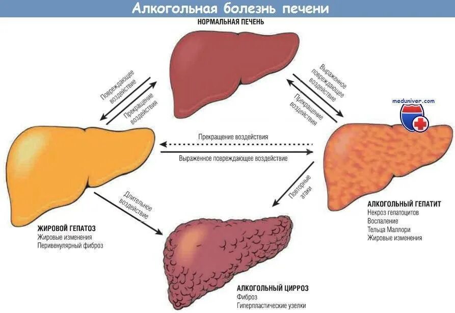 Названия печени фото Цирроз и фиброз печени клинические рекомендации