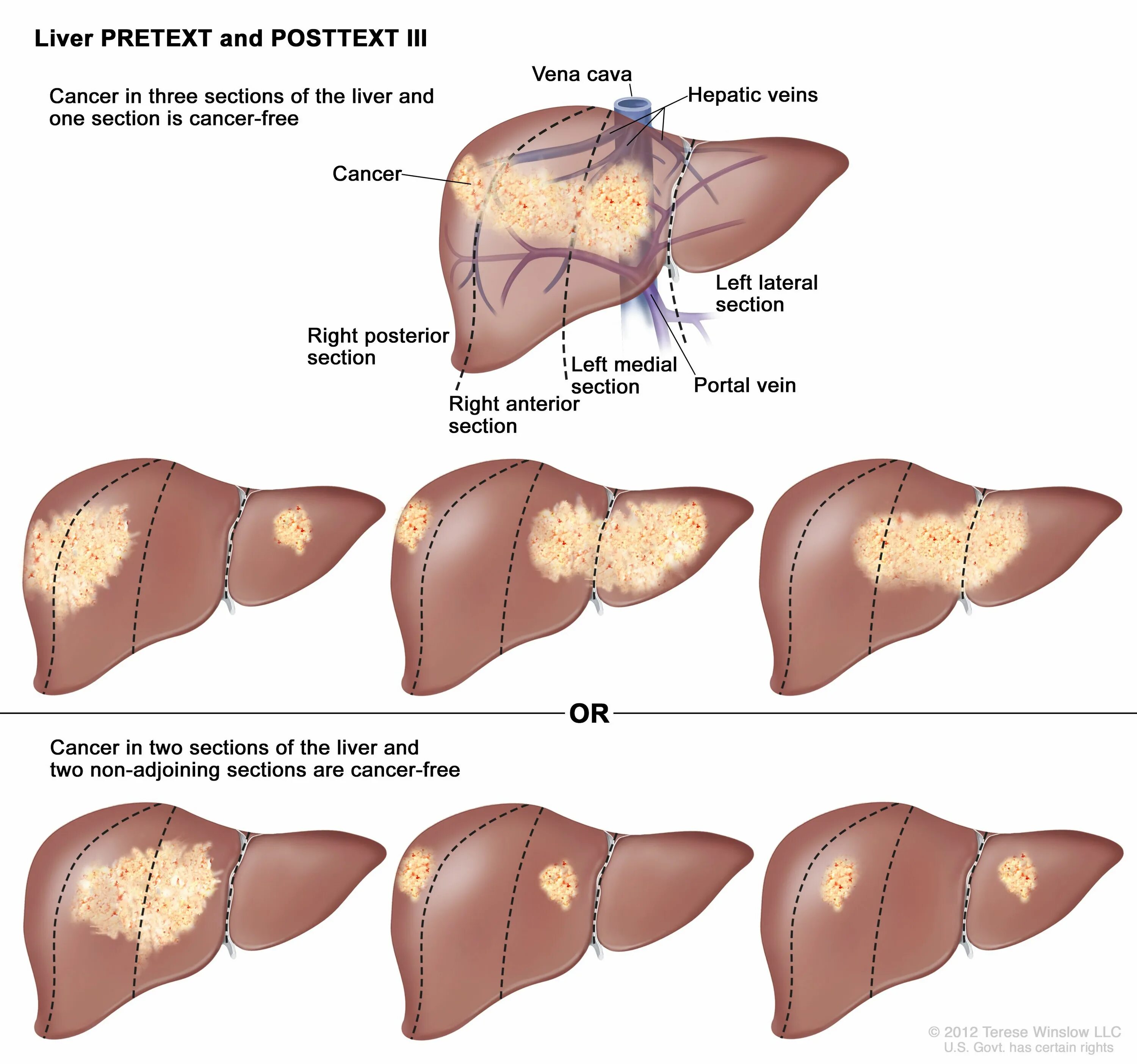 Названия печени фото Childhood Liver Cancer Treatment (PDQ ®) - NCI