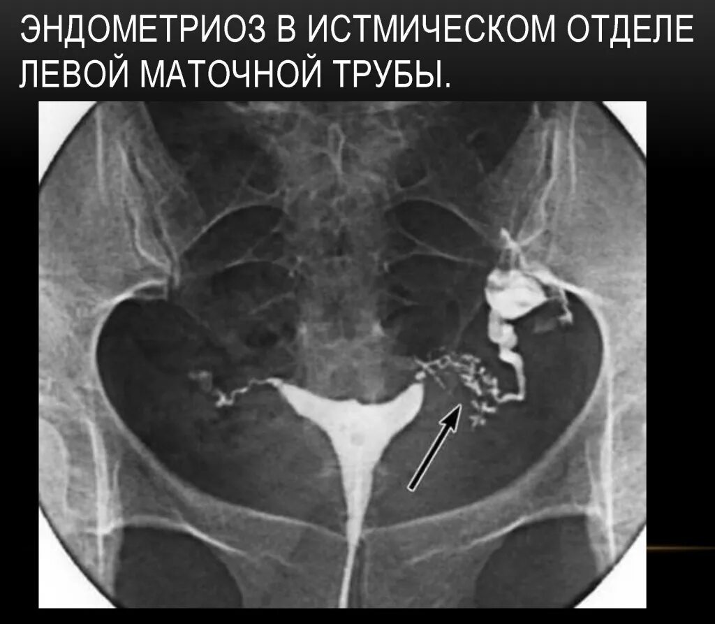 Не проходимость труб гинекология как определить фото ГСГ
