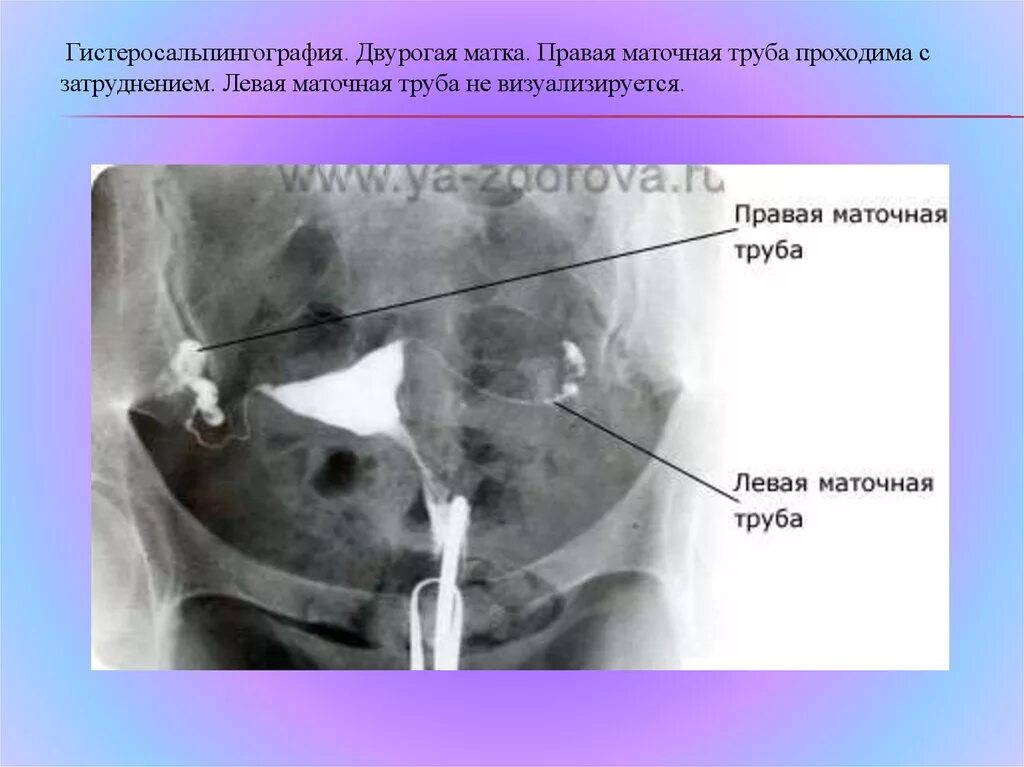 Не проходимость труб гинекология как определить фото Гсг наркоз: найдено 76 изображений