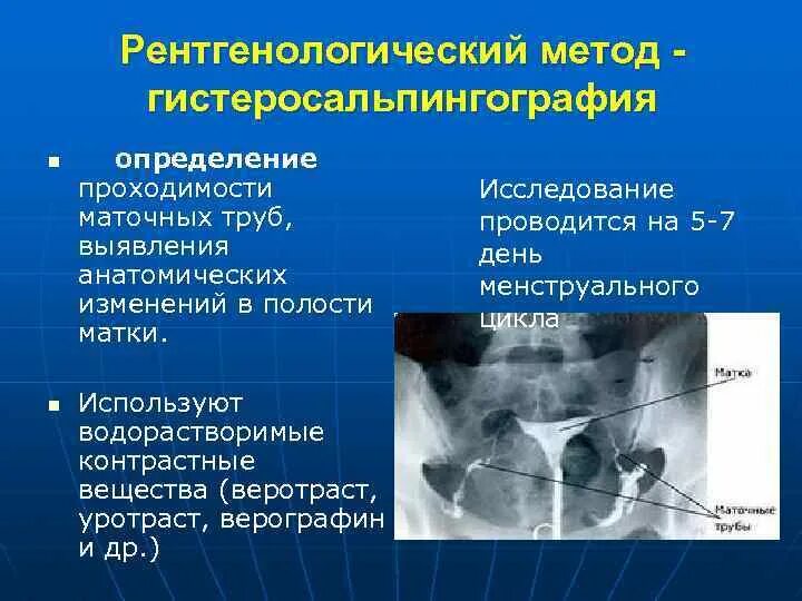 Не проходимость труб гинекология как определить фото Методика гистеросальпингографии рисунок