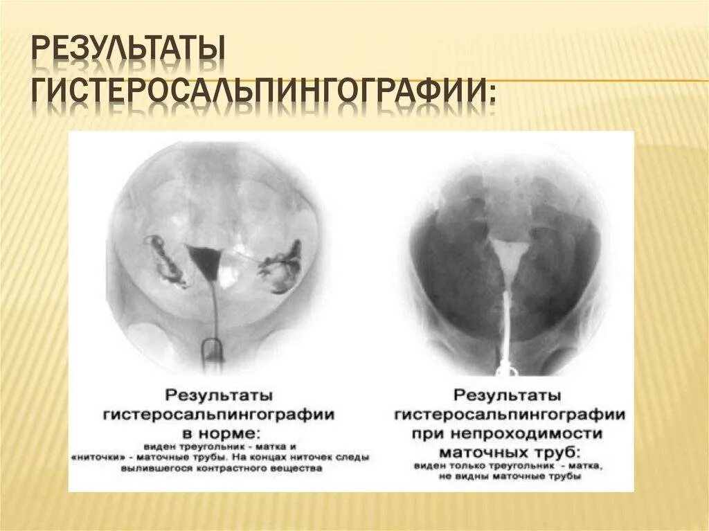 Не проходимость труб гинекология как определить фото Гсг рентген маточных