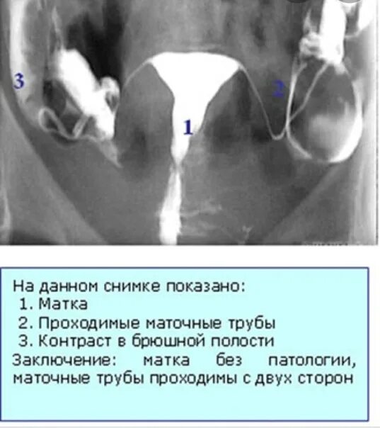 Не проходимость труб гинекология как определить фото Больно ли проверить проходимость маточных - найдено 80 картинок