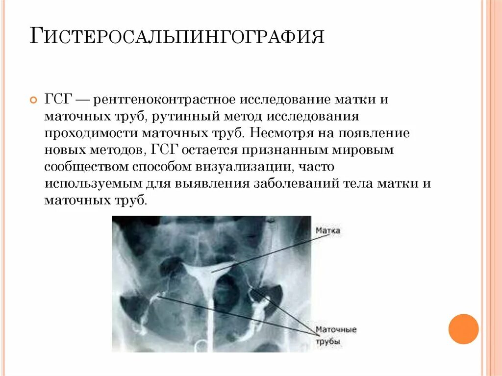 Не проходимость труб гинекология как определить фото Гистероскопия гистеросальпингография