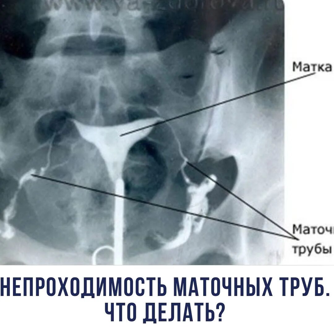 Не проходимость труб гинекология как определить фото Как делают проходимость труб у женщин
