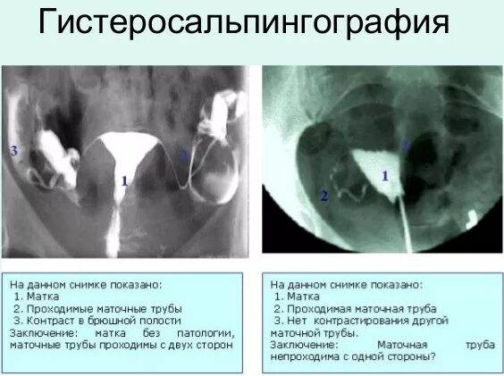 Не проходимость труб гинекология как определить фото Картинки ПРОВЕРКА МАТОЧНЫХ ТРУБ ФОРУМ